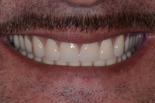 Patient 6 After